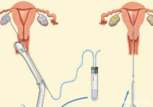 第三代试管能否通过技术筛查出地贫基因